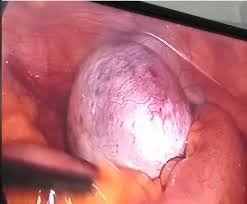 Feb 11, 2020 · @alwaysclau: Successfully Removed 8cm Dermoid Cyst By Laparoscopy Satisfied Pt Dermoid Is A Type Of Ovarian Cyst Which Contains Hair Teeth Fat So A Challenge To Dr Somya