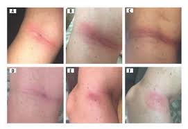 Dark dots on the surface that correspond mainly to blood in tubular lumens and in bowman's spaces. Healthcare Free Full Text Presentation Of Acrodermatitis Chronica Atrophicans Rashes On Lyme Disease Patients In Canada Html