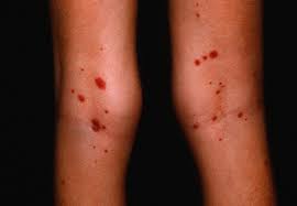 Individuals with sjögren's may develop a skin rash. Henoch Schonlein Purpura Causes Symptoms Prognosis Treatment