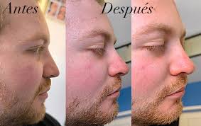 Armonización facial