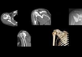 Image result for Shoulder Imaging