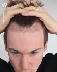 Incredible Hair Transplant Results