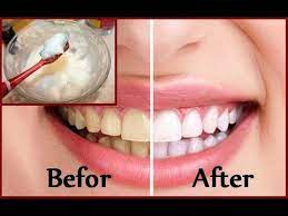 White teeth are a huge part of a bright, healthy smile, so it's normal if you want to try and whiten your teeth. Diy Teeth Whitening At Home In 2 Minutes Youtube