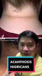 Repost ACANTHOSIS NIGRICANS #diabetes #fypシ #f #foryourpage  #acanthosisnigricans