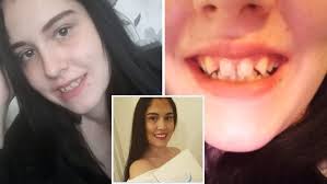 British mum says 'amazing' Fab Smile Veneers transformed her crooked teeth 