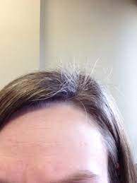 A mom got real about postpartum hair loss — and tiktokers are loving her brutal honesty and her impressive hair horn trick!. New Hair Growth After Post Baby Hair Loss July 2016 Babies Forums What To Expect