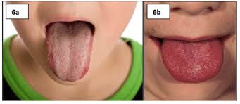 Check spelling or type a new query. Le Malattie Esantematiche Nei Neonati E Nei Bambini Come Riconoscerle