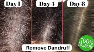 This homemade recipe for dandruff baking soda should be applied with a gentle massage on your scalp, after moistening it a bit. Wellice Garlic Anti Dandruff Shampoo 400g