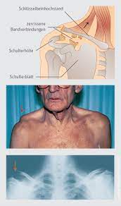 Schlusselbeinbruch