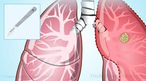 Image result for Lung Cancer
