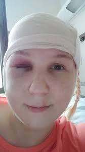 Surgeons in Sarasota or Tampa for AVM treatment?