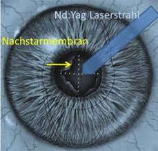 Yag Kapsulotomie Behandlung Fur Klaren Durchblick