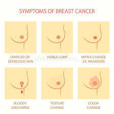 Swelling can also occur around your collarbone or armpits. Symptoms Of Breast Cancer Stock Vector Illustration Of Dimpling 60167212