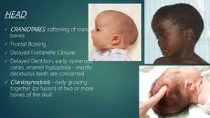 Image result for Craniotabes