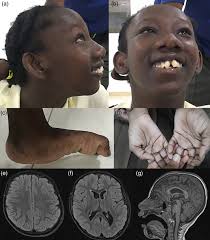 Expanding the clinical phenotype and variant spectrum associated with RFX7 