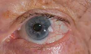 An optometrist is a health care professional trained to examine the eye. Eye Cancer Symptoms Warning Signs Of The Deadly Disease Including Blurred Vision A Lump Express Co Uk