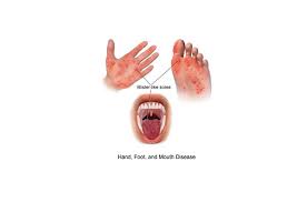 Image result for Hand foot and mouth disease HFMD roof of mouth
