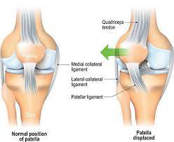 Nyc Chondromalacia Patella Treatment Doctor (Knee Pain Specialist) · Sports  Injury Clinic