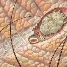 An orten wie bett und sofa leben vor allem krätzmilben. Angst Vor Kratze Skabies Das Sollten Sie Uber Die Parasiten Kratzmilben Wissen Gesundheit