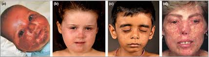 Patients with xeroderma pigmentosum complementation groups C, E and V do  not have abnormal sunburn reactions