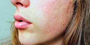 Ask A Dermatologist Rosacea 101 Columbia Skin Clinic