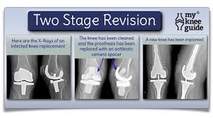 Infection After Knee Replacement Knee Replacement Total Knee Replacement Knee Replacement Surgery