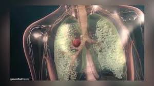 Nicht Kleinzelliges Bronchialkarzinom Youtube