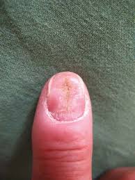 Image result for Akutní zánět nehtového lůžka