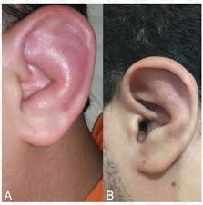 Image result for Relapsing Polychondritis