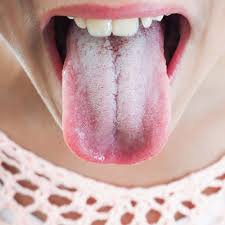Follow these things like brush your tongue gently, scrape the tongue, rinse with water thoroughly, use strong antiseptic solution for gargle and scrub your tongue to get rid of the problem. White Tongue Causes 10 Natural Treatments For White Tongue Dr Axe