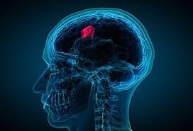 Brain Cancer Types Symptoms Signs Causes Stages Treatment
