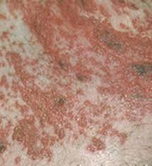 Image result for shingles