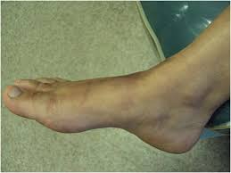 Image result for Leiomyosarcoma