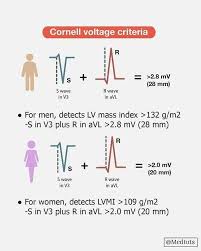 For the first two thirds of the cohort, ecgs were analyzed manually, whereas after exclusion of all of the patients presenting lvh by the sokolov criteria, 569 patients were left for. Medicine Pg Resident Twitter àªªàª° Ecg Criteria For Left Ventricular Hypertrophy Sokolow Lyon Criteria Cornell Voltage Criteria Foamed Meded Medtwitter Cardiotwitter Cardiology Ecg Ekg Cardioed Mrcp Usmle Fcps Plab Epeeps Https T Co