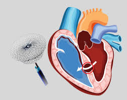 Image result for Ventricular Septal Defect