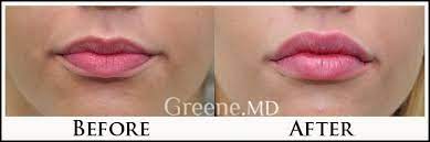 Customized Lip Enhancement With Juvederm Filler This Patient Wanted Fuller More Defined Lips Facial Filler Lip Augmentation Lip Enhancement Facial Fillers