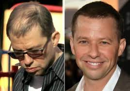 Visit dynamic clinic we have. Hollywood Celebrities Using Hair Fiber Say It Isn T So Dr Hair Usa