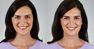 How long do restylane treatments last? How Long Do Dermal Filler Results Last Skin Cancer Specialists P C