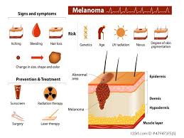Although it may not be serious, a mole that bleeds is a possible sign of melanoma. Endometriosis And Skin Cancer Extrapelvic Not Rare