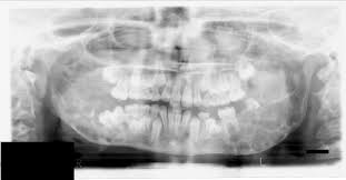 Cherubism is a rare genetic condition that leads to the prominence of the lower part of the face. Late Reactivation Of Cherubism In A Patient With New Onset Polycystic Ovary Syndrome Journal Of Oral And Maxillofacial Surgery
