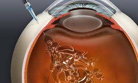 Check spelling or type a new query. Anti Vegf Treatments For Macular Degeneration And Retinal Vein Occlusion