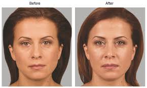 Clinical trial ended at 25 months. Sculptra Los Angeles Wrinkle Treatment Santa Monica