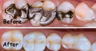 The procedure is quite straightforward and shouldn't take about an hour to complete. Tooth Fillings Markham Dental Cavity Fillings Markham On