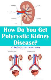Kidney Function Stones Polycystic Kidney Disease Kidney Disease Stages Kidney Dialysis
