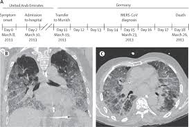 Einmal wöchentlich wird ein podcast mit dem in deutschland sehr bekannten virologen christian drosten veröffentlicht. Clinical Features And Virological Analysis Of A Case Of Middle East Respiratory Syndrome Coronavirus Infection The Lancet Infectious Diseases