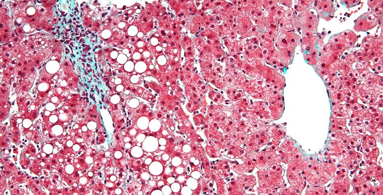 Résultat de recherche d'images pour "liver fat""