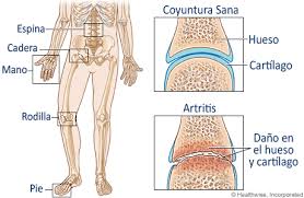 Resultado de imagen para artritis reumatoide imagenes