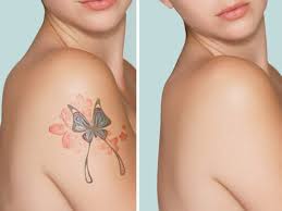 After you've rubbed your skin with salt, apply antibiotic ointment to the area and cover it for 3 days. The Cosmetic Vein Laser Center Laser Tattoo Removal