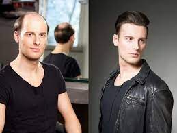 Discover the best hairstyles and most popular haircuts for men from classic to trendy. Hair Weaving Bonding For Men Buy Men Hair Weaving In Howrah West Bengal