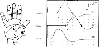 Comparison Of Motor Conduction Techniques In The Diagnosis Of Carpal Tunnel Syndrome Neurology